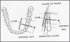 Figure 56 - Mandibular Premolars