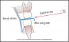 Figure 60 - Bitewing Placement