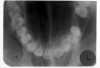 Figure 68 - Maxillary Vertex Occlusal Image