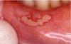 Figure 1. Chemotherapy induced mucositis. Courtesy of dentalcare.com