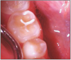 Figure 2 – Erosion Due to Soda Pop Consumption.<sup>25</sup>