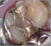 Figure 3 – Erosion. Courtesy of Dr. Peter Endo.