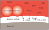 Figure 4 – Acid Induced Erosion of Teeth<sup>19</sup>