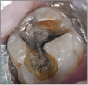 Figure 6 – Erosion. Courtesy of Dr. Peter Endo.