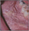 Figure 7 – Squamous cell carcinoma. Image provided by: Dr. JE Bouquot