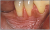Figure 9 – Gingival Attachment Loss. Image provided by: Dr. JE Bouquot