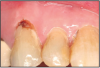 Figure 5 – Root caries on an exposed root surface