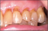 Figure 6 – Loss of periodontium with subsequent loss of tooth structure and contour