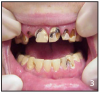 Figures 3 and 4 Rampant Decay – Photos courtesy of: Sharlee Shirley, RDH, MPH; Jim Cecil, DMD, MPH, University of Kentucky, School of Dentistry United States Department of Justice Meth Awareness Program