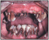 Figures 3 and 4 Rampant Decay – Photos courtesy of: Sharlee Shirley, RDH, MPH; Jim Cecil, DMD, MPH, University of Kentucky, School of Dentistry United States Department of Justice Meth Awareness Program