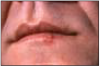 Figure 4 – Cold Sore