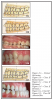 Fig 11. (A) Normal Occlusion; (B) Class II Malocclusion; (C) Class II Division 1; (D) Class II Division 2; (E) Class III; (F) Class III Anterior Bite.