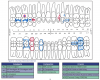 Fig 16. Charting of Restorative Materials.