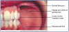 Figure 6 – Buccal Mucosa (Courtesy of Modern Dental Assisting, 10th Edition, Bird et al, Figure 10.5). Photograph of mucosa in the back of the mouth.