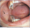 Figure 7 – Linea Alba (Courtesy of Modern Dental Assisting, 10th Edition, Bird et al, Figure 10.7). Example of a linea alba in the patient’s cheek.