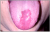 Figure 3 – Erythematous candidiasis related to xerostomia.