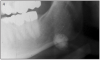 Figure 4 – Radiograph of a sialolith.