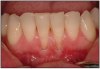 Figure 11 – Gingival Recession