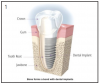 Figure 1 – Comparison between the tooth (left side) and implant (right side) attachment into bone (Courtesy of Nobel Biocare)