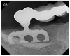 Figure 2A – Blade implant design