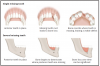 Figure 7 – Bone loss is the end result of tooth loss