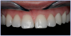 Figure 8 – Implant restoration on tooth #11 (Courtesy of Dr. Dell Goodrick)