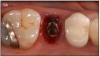 Figure 9A – Internal connection implant system – implant placed
post-extraction