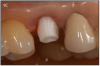 Figure 9C – Zirconia abutment torque onto implant