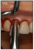 Figure 11A – Extraction of anterior tooth (#8) without detaching the gingiva
