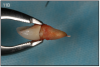 Figure 11B – Extracted tooth with the root canal material (gutta percha) extending from the apex