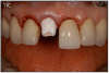 Figure 11C – A zircon (white) abutment was attached immediately following the extraction and implant placement