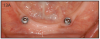 Figure 13A – Mandibular, two-implants with O-rings to support the overdenture