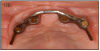 Figure 13B – Maxillary bar that attaches the overdenture