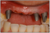 Figure 22A – Titanium custom abutments