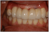 Figure 22B – Metal-free fixed partial denture cemented on abutments
