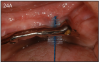 Figure 24A – Proxybrush is a great tool to clean under the overdenture bars