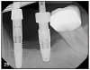 Figure 25 – Radiograph showing significant bone loss around the implant, one year after placement