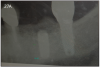 Figure 27A – Radiograph of fractured posterior implant