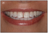 Figure 28 – Smile of patient with a dental implant