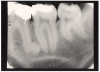 Figure 1 – Periapical Image