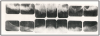 Figure 7 – Edentulous Full Mouth Series