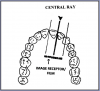 Figure 14 – Maxillary Central/Lateral Incisors