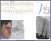 Figure 19 – Maxillary Canines