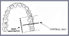 Figure 23 – Maxillary Molars