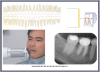 Figure 37 – Mandibular Molars