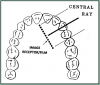 Figure 43 – Maxillary Canines