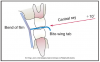 Figure 60 – Bitewing placement