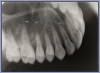 Figure 72 – Posterior Oblique Maxillary Occlusal Image