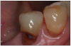 Figure 1. Root caries. Courtesy of dentalcare.com