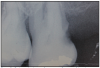 Figure 2. Radiographic Image of root caries. Courtesy of dentalcare.com